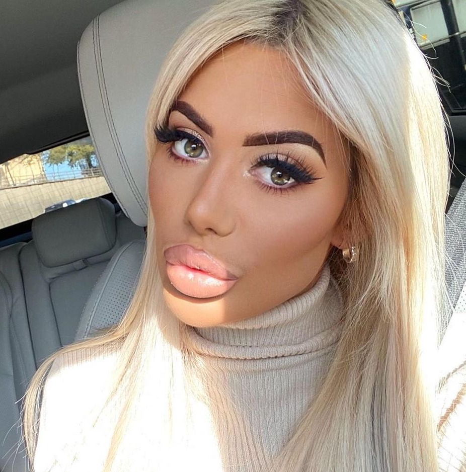 Chloe Ferry said she suffered years of 'abuse' and being called 'fish lips' and 'duck lips'