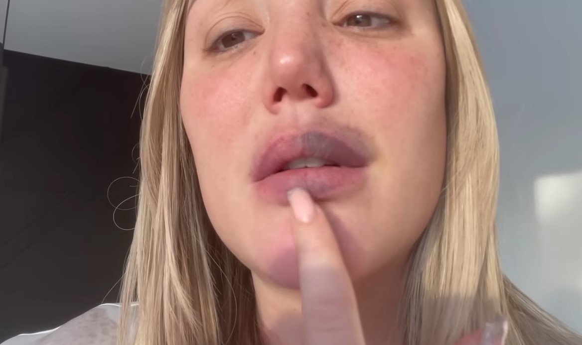 The mum-of-one revealed her lips after the filler removal
