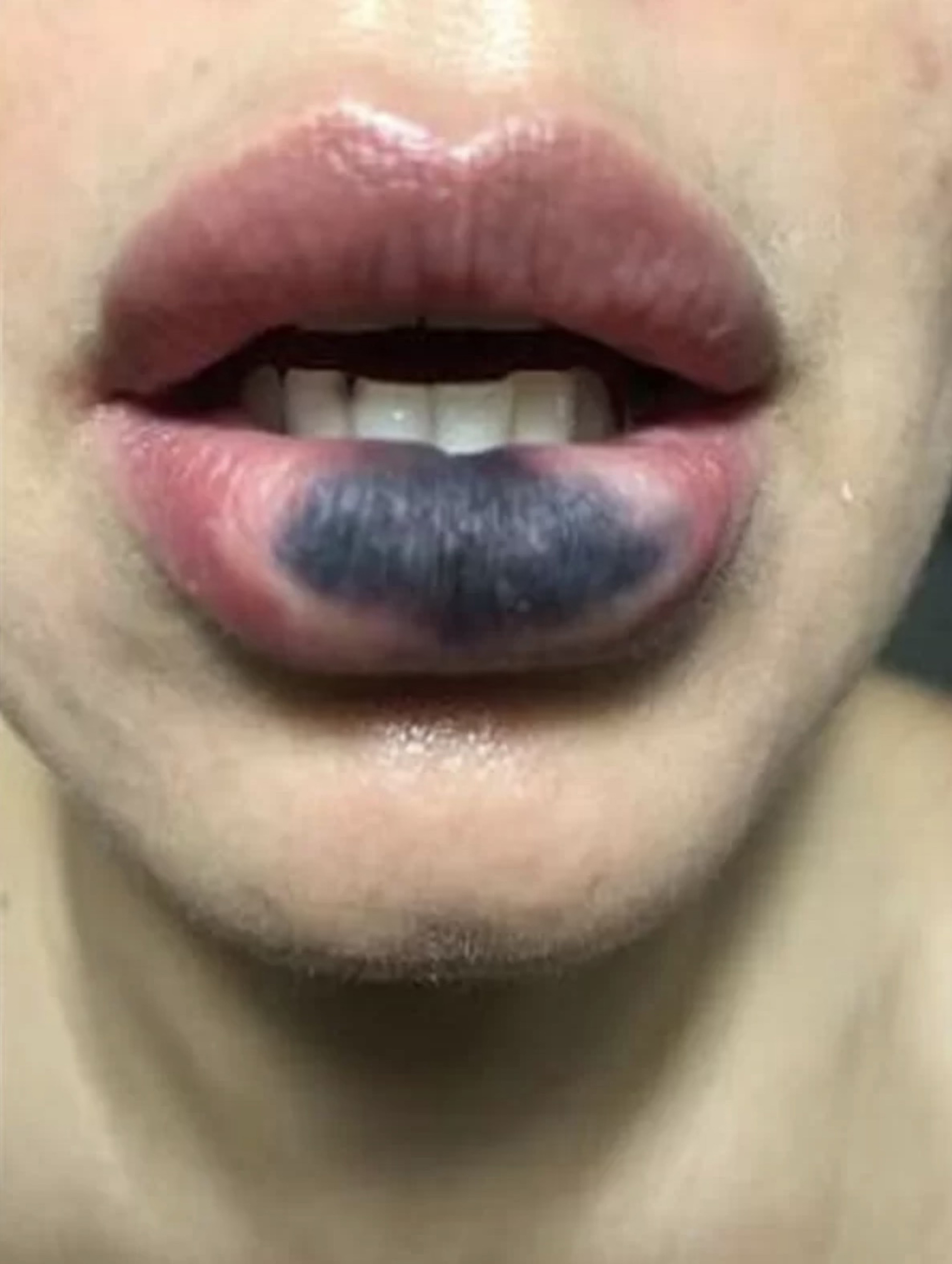 Eine andere Frau übermittelte der Polizei Bilder ihrer geschwärzten Lippe
