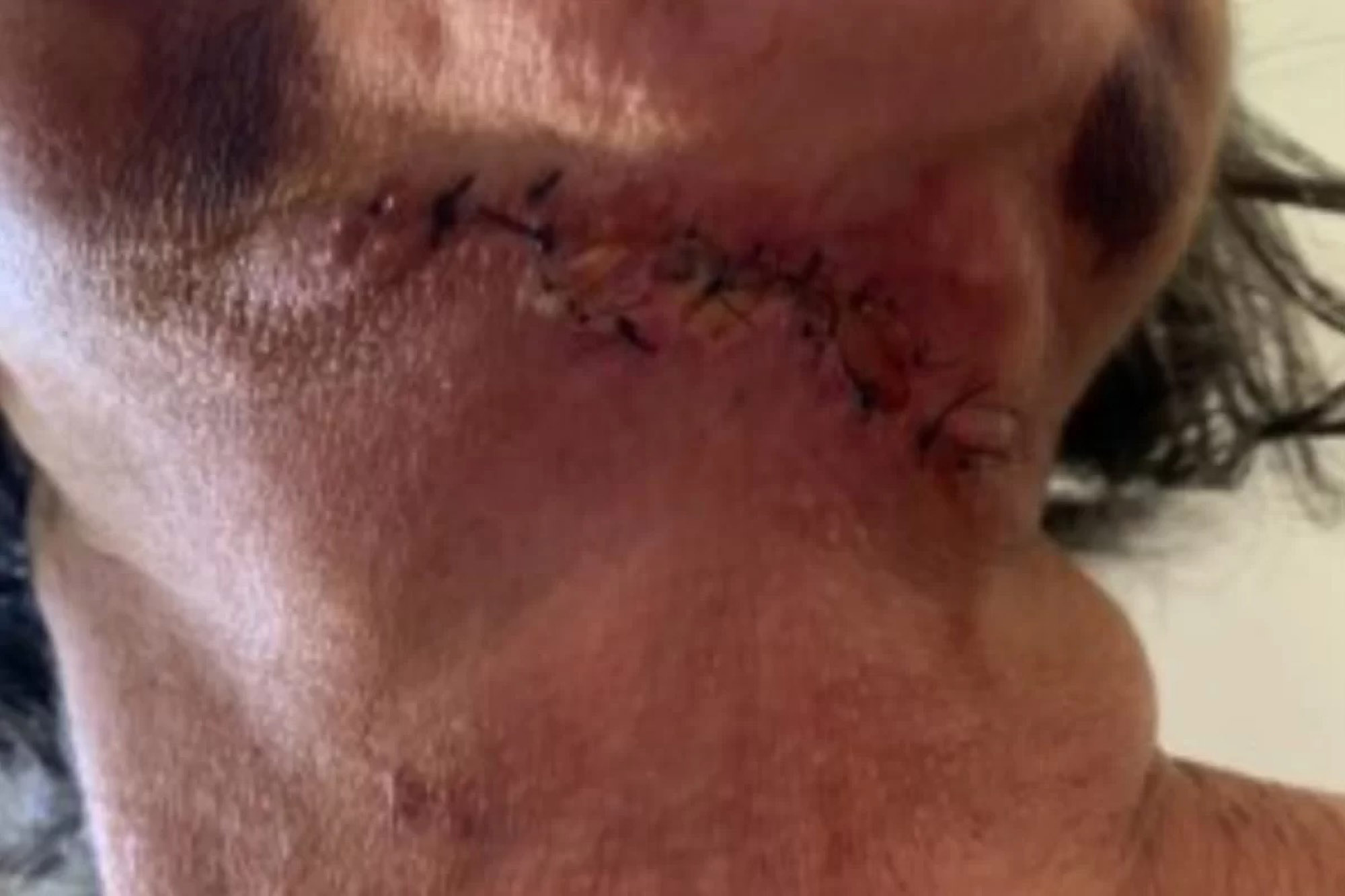 Ein drittes Opfer hat eine Frankenstein-ähnliche, gezackte Narbe am Hals