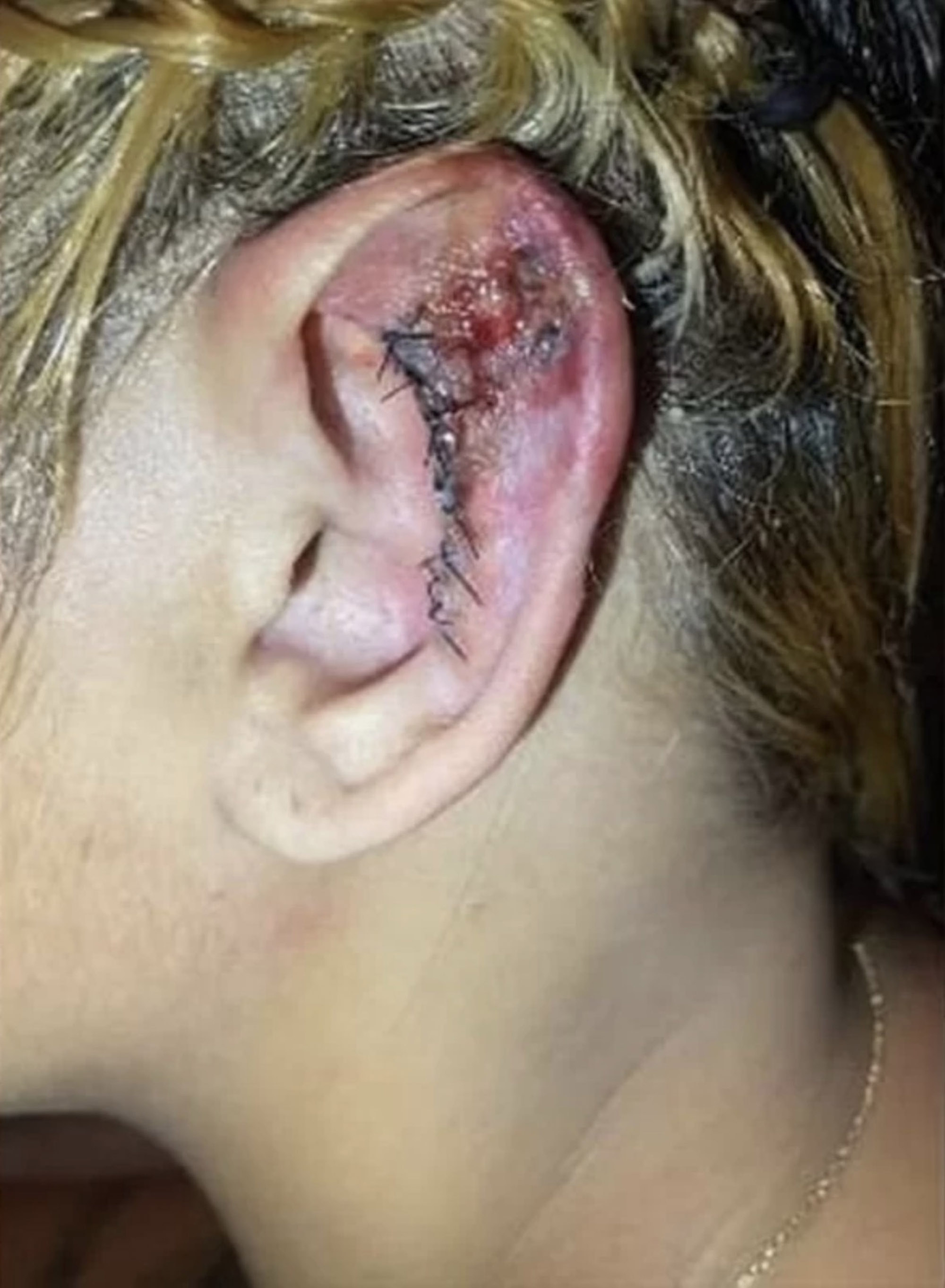 Das Ohr einer Frau sieht neben dicken Nähten, die Berichten zufolge nach einem Eingriff in der Klinik entstanden sind, völlig entzündet aus