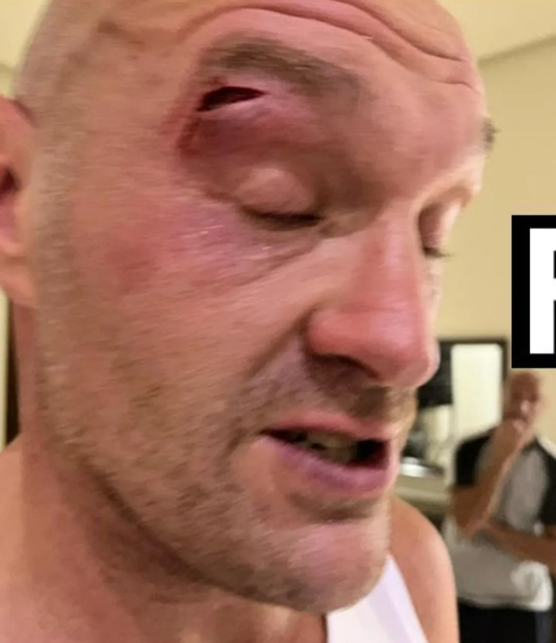 Fury zog sich aus dem Kampf zurück, nachdem er sich eine Schnittwunde im Gesicht zugezogen hatte