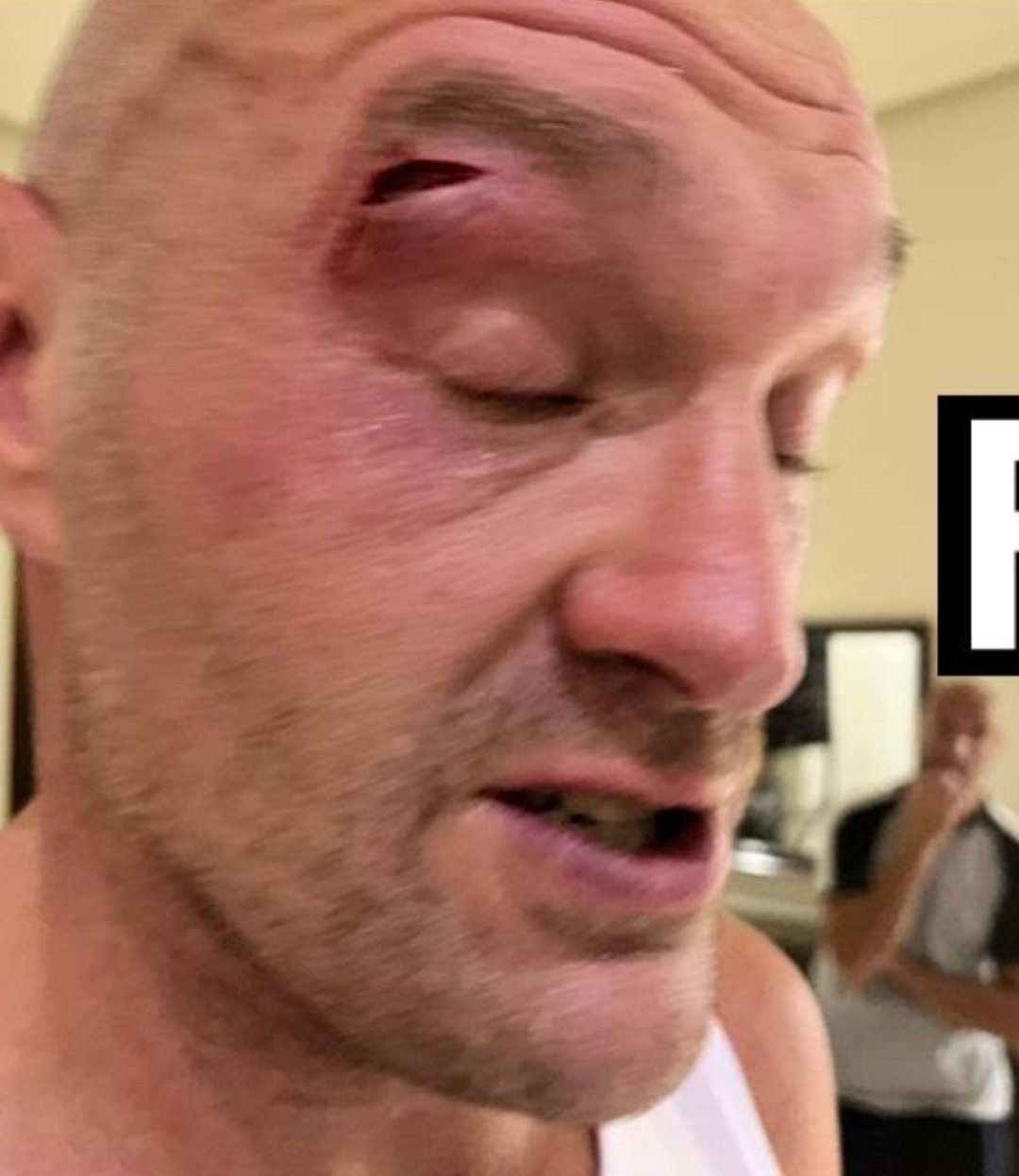 Tyson Furys Horrorschnitt, der den Usyk-Kampf verschob