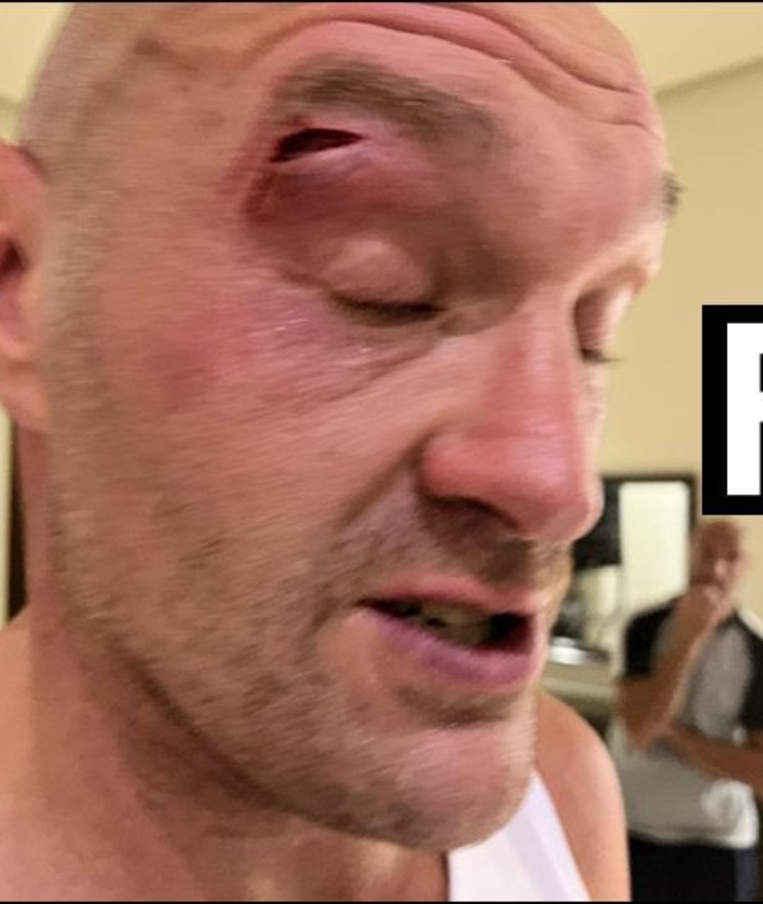 Tyson Fury verschob den Kampf, nachdem er sich beim Sparring eine schwere Schnittwunde am Auge zugezogen hatte