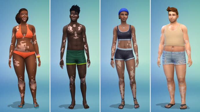 Vitiligo-Beispiele in Die Sims 4 (Körper)