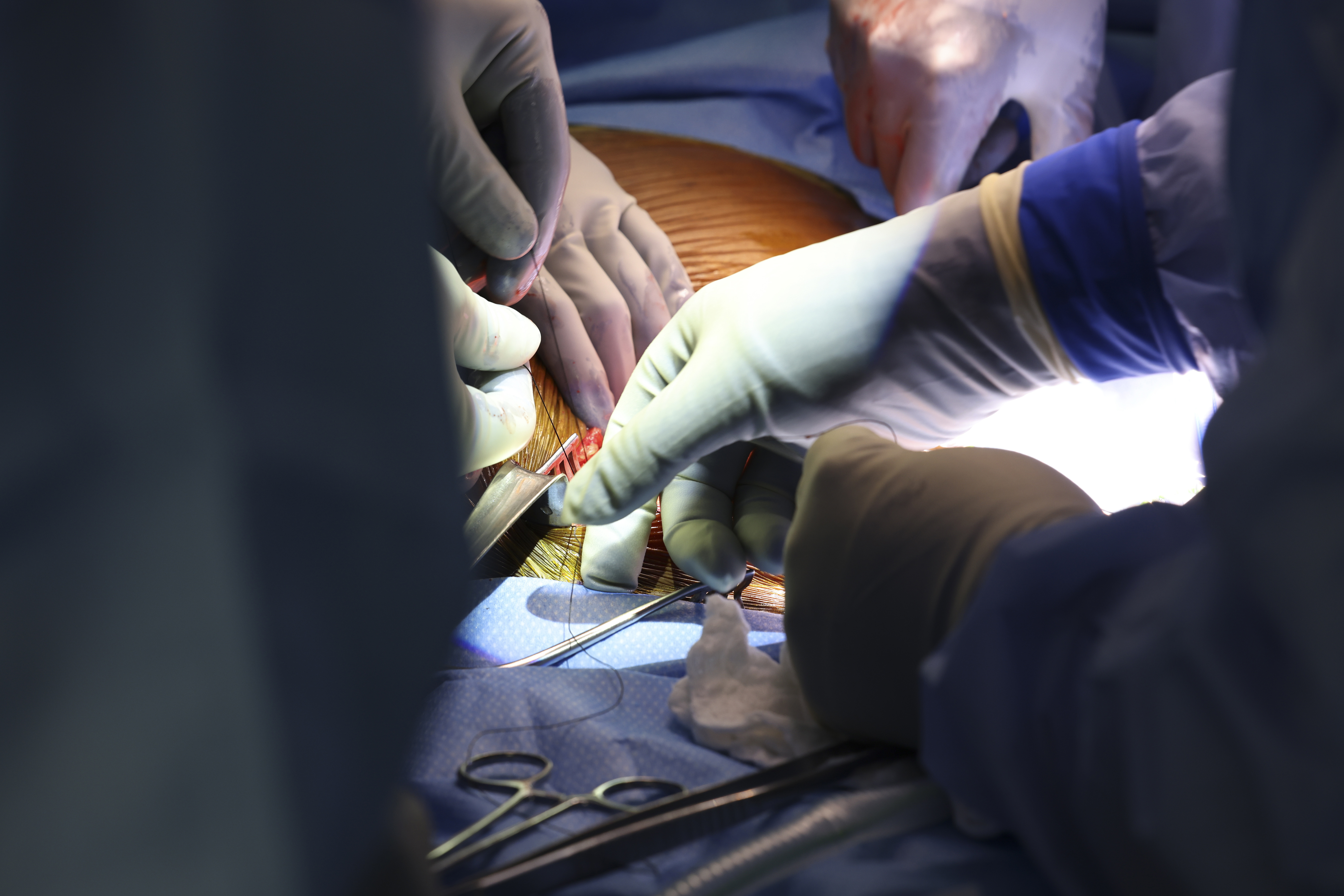Chirurgen sagten, der Eingriff sei ein Erfolg gewesen und könne Hoffnung für andere Patienten mit Nierenerkrankungen geben