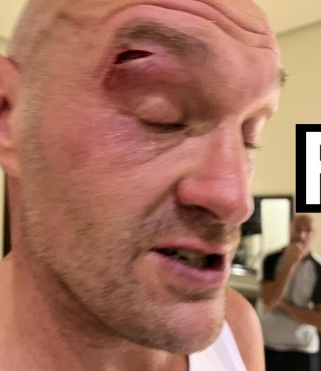 Der Boxer erlitt eine schlimme Schnittwunde über dem Auge