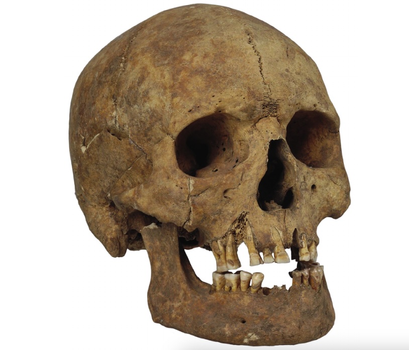 Ein Schädel eines Mannes mit gefeilten Zähnen und einem verheilten Bruch aus dem wikingerzeitlichen Gotland