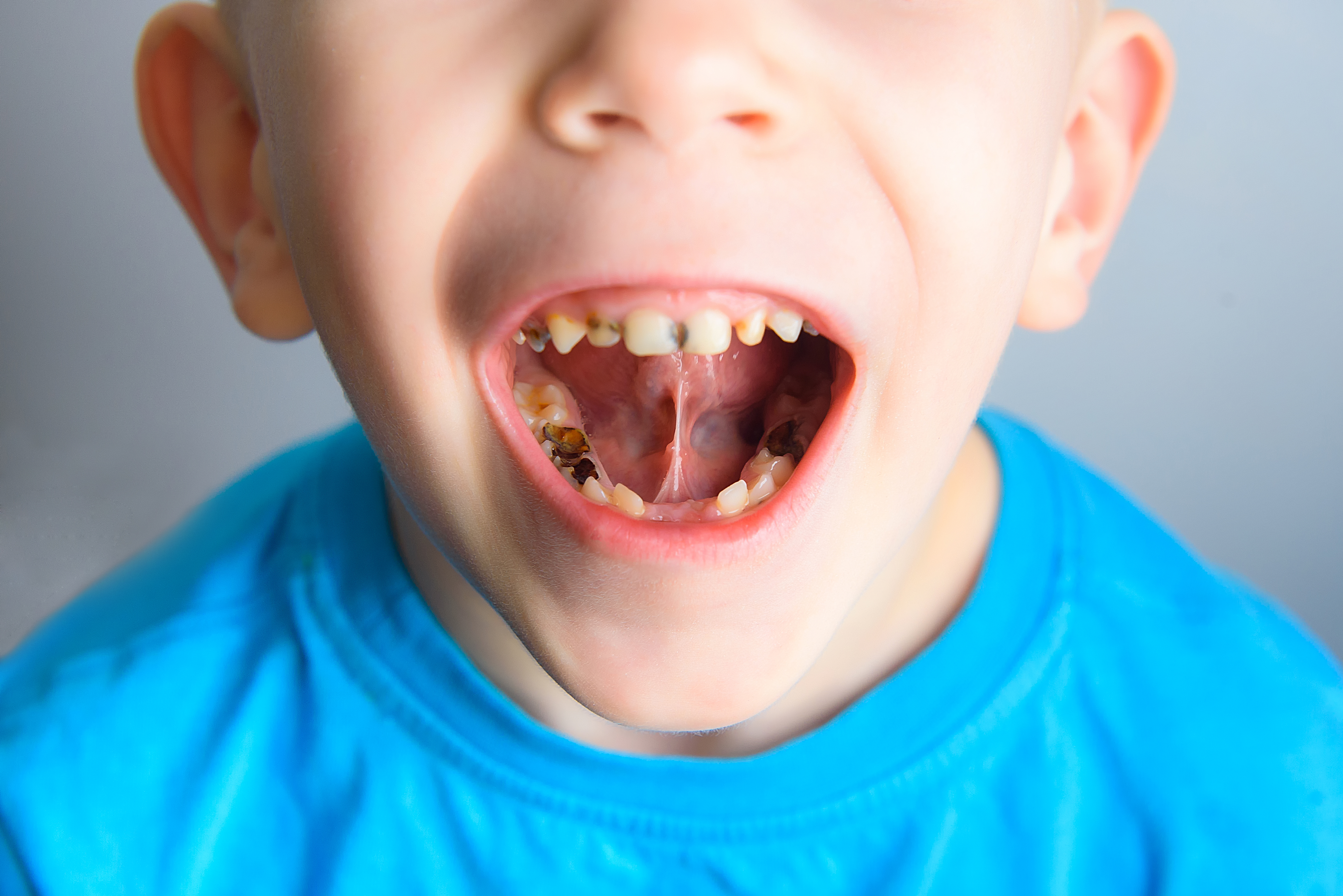 Tooth decay is another risk factor that comes with kids' consumption of energy drinks